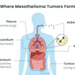 where-mesothelioma-tumors-form-genome