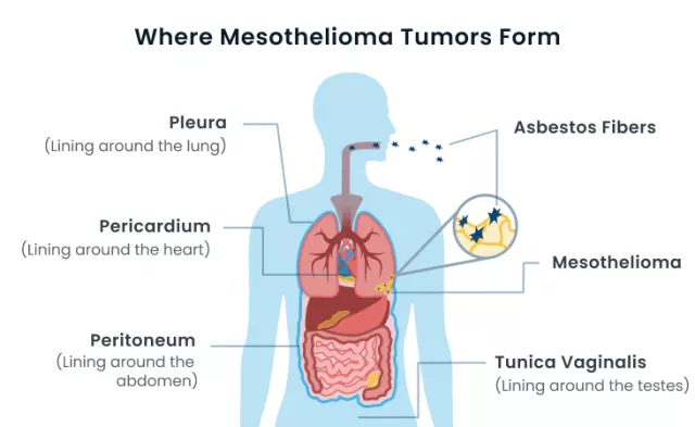 where-mesothelioma-tumors-form-genome